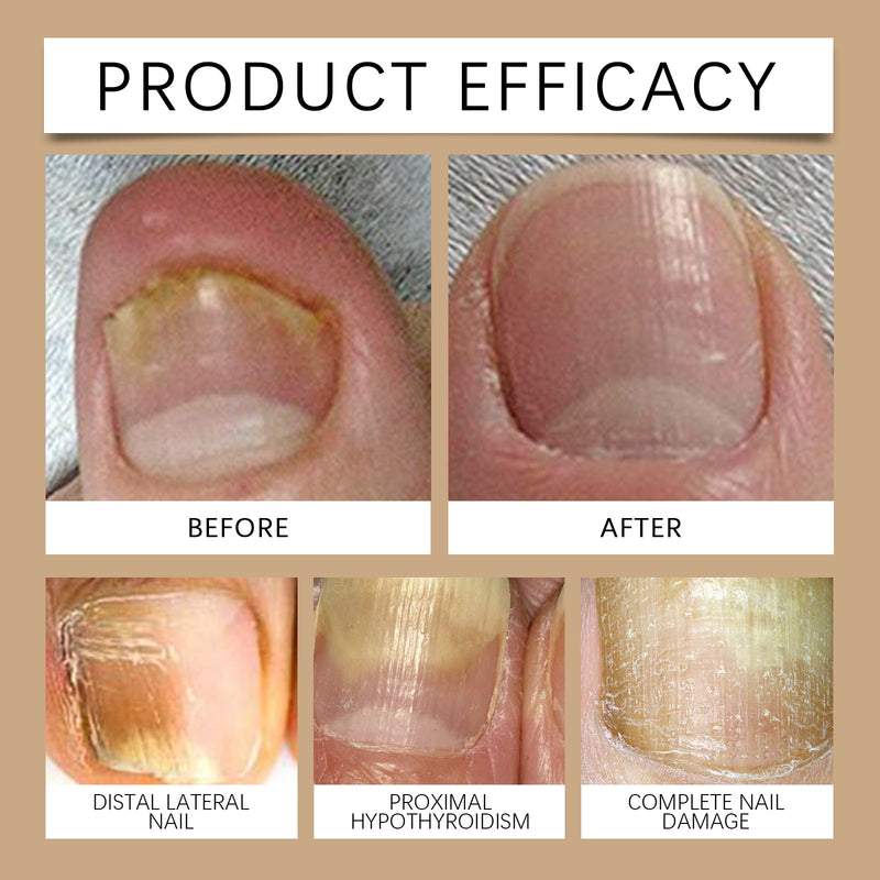 Onychomycosis Care Spray, Nail Spray Soft Nail Thick Nail Antibacterial Spray