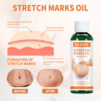 OUHOE Pregnancy Massage Oil, Repair Pregnant Women Prenatal And Postpartum Stretch Mark Skin Care Massage Oil