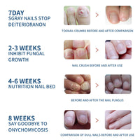 EELHOE Fungal Nail Patches, Toenail Care Soft Nail, Inlay Nail And Thickening Nail Repair Patch