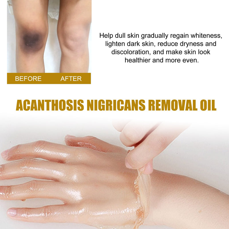 West&Month Acanthosis Nigricans Removal Oil, Exfoliating Light Black Brightening And Beauty Skin Oil