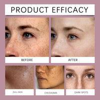 Melasma Spotless Concentrate, Moisturizing Firming Skin Refreshing And Dark Spots Skin Creams