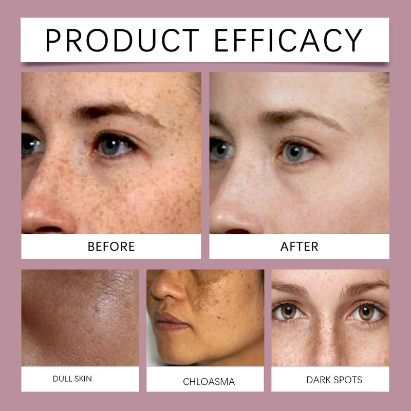 Melasma Spotless Concentrate, Moisturizing Firming Skin Refreshing And Dark Spots Skin Creams