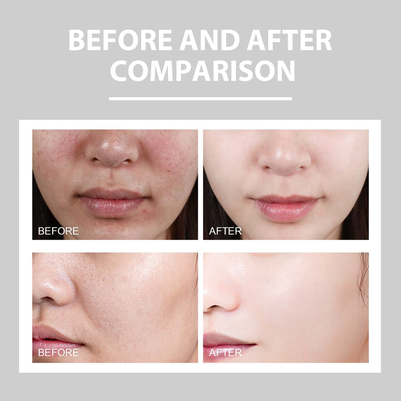EELHOE Hydrating Cream - Lightens Acne Redness, Brightening Moisturizing Care