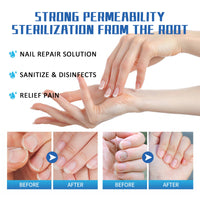 South Moon Nail Fungus Treatment Method, Repair Grey Nail Brightening Nail Thickening Nail Hand And Foot Nails Moisturizing Care Cream