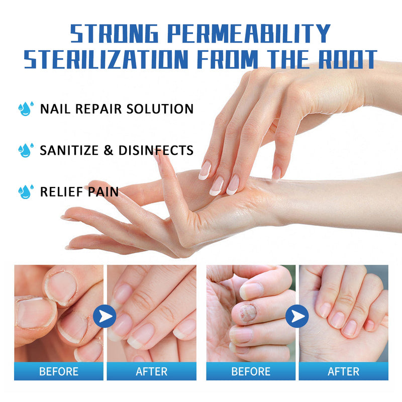 South Moon Nail Fungus Treatment Method, Repair Grey Nail Brightening Nail Thickening Nail Hand And Foot Nails Moisturizing Care Cream