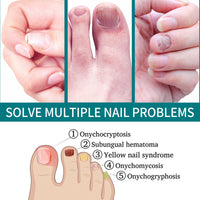 Nail Repair Patch, Hand And Foot Nail Care Soft Nail Inlay Nail Thickening Gray Nails Bright Nails Patch