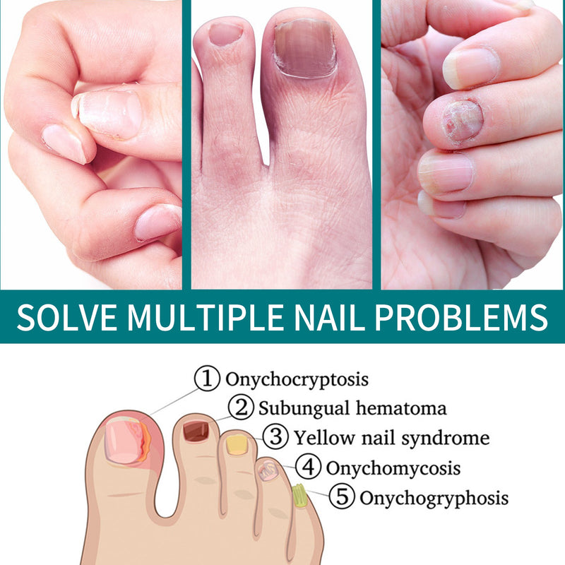 Nail Repair Patch, Hand And Foot Nail Care Soft Nail Inlay Nail Thickening Gray Nails Bright Nails Patch