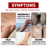 EELHOE Venous Massage Varicose Cream, Relieves Bulging Leg Blood Vessels And Swollen Leg Earthworm Venous Massage Cream