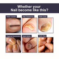 OUHOE Nail Repair Essence, Soft Nail Thickening Nails Smooth Ingrown Toenails Grey Nails Repair Essence