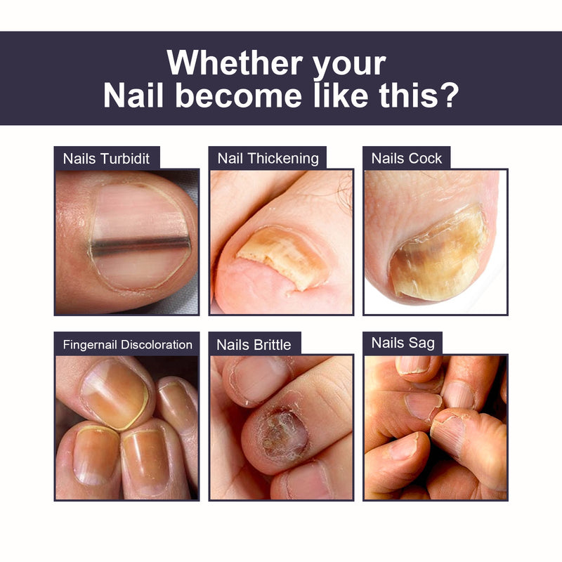 OUHOE Nail Repair Essence, Soft Nail Thickening Nails Smooth Ingrown Toenails Grey Nails Repair Essence