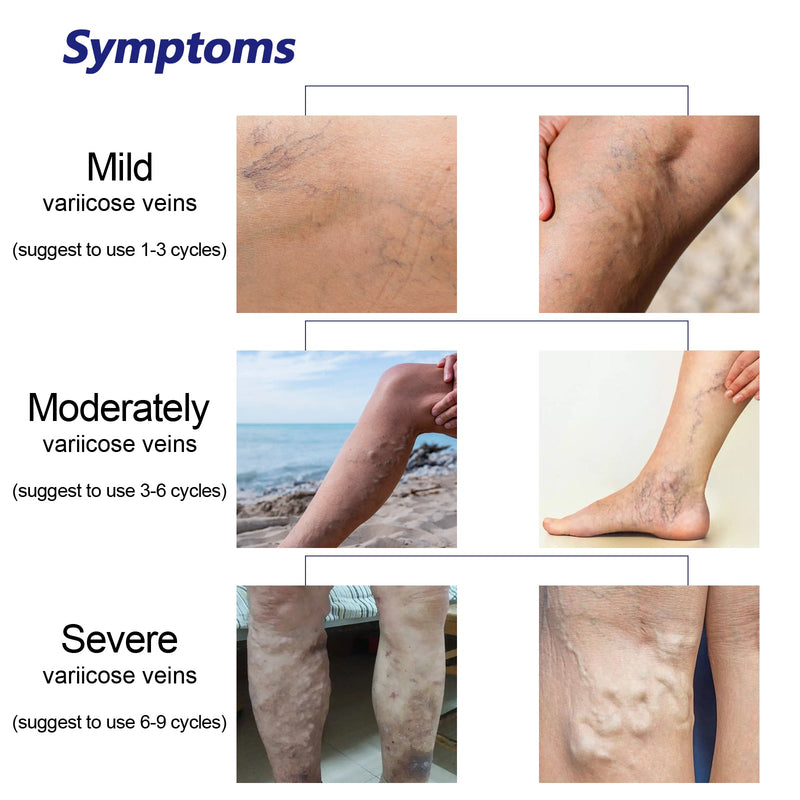 OUHOE Intravenous Spray, Relief Of Varicose Blood Vessel Bulge Pain Intravenous Massage Treatment Spray