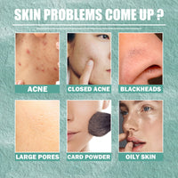 Cystic Acne Treatment, Acne Removing Face Repair Cream For Closed Pimples And Acne Marks