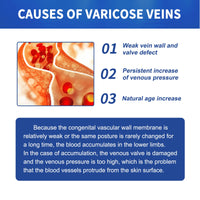 South Moon Vein Massage Varicose Cream Repair Earthworm Legs To Relieve Leg Blood Vessel Bulge And Varicoidea
