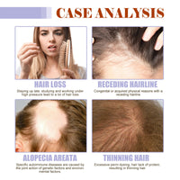 Dense Hair Supplement, Moisturizes Hair Roots, Strengthens Hair, Softens Hair And Prevents Hair Loss