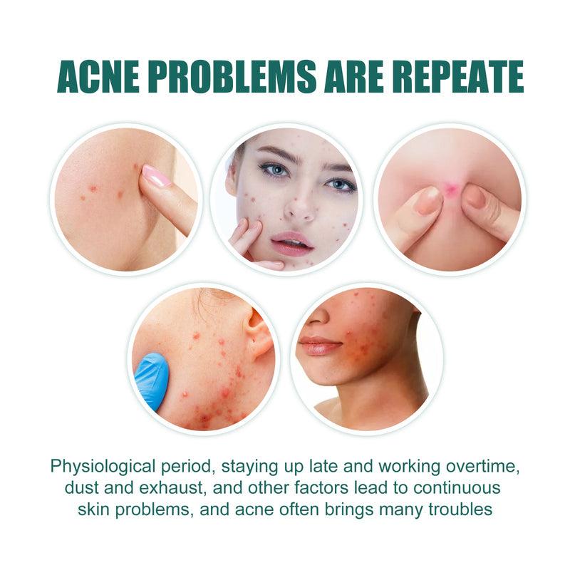 EELHOE Star Acne Patch Gentle Cleansing Lighten Acne Soothing Skin Acne Patch Facial Cleansing Treatment