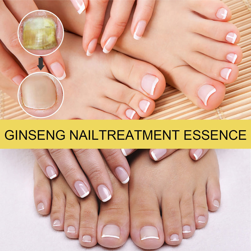 EELHOE Ginseng Nail Essential Oil Grey Nail Thickening Nail Repair Brightening Nail Removing Soft Nail Moisturizing Essence