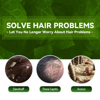 Tinea Capitis Anti-Itch Shampoo Anti-Drop Refreshing Oil Control Hair Care Anti-Dandruff Anti-Itch Shampoo