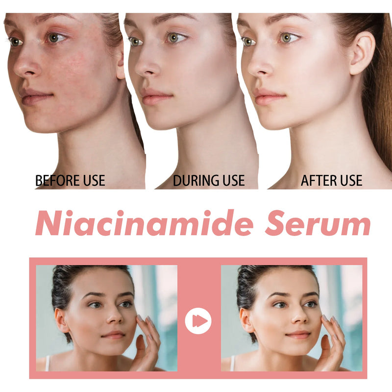 Hoygi Nicotinamide Essence Tights And Moisturizes Pores, Lighens Acne Marks And Spots, Moisturizes And Brighens Skin