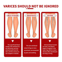 South Moon Varicose Veins Cream, Leg Massage Treatment Soreness Relief Repair Varicose Body Care Cream