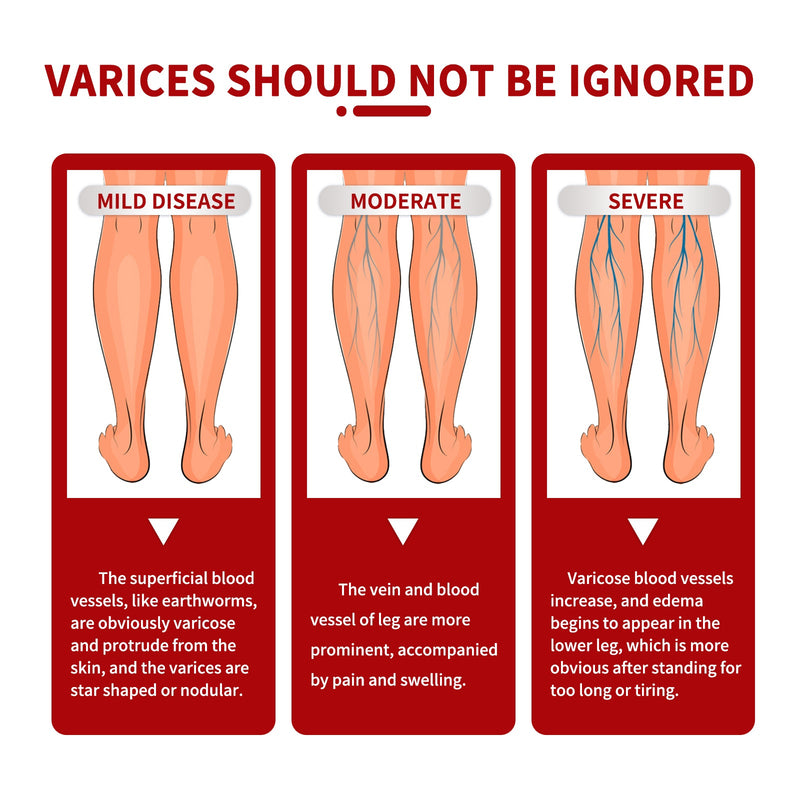 South Moon Varicose Veins Cream, Leg Massage Treatment Soreness Relief Repair Varicose Body Care Cream
