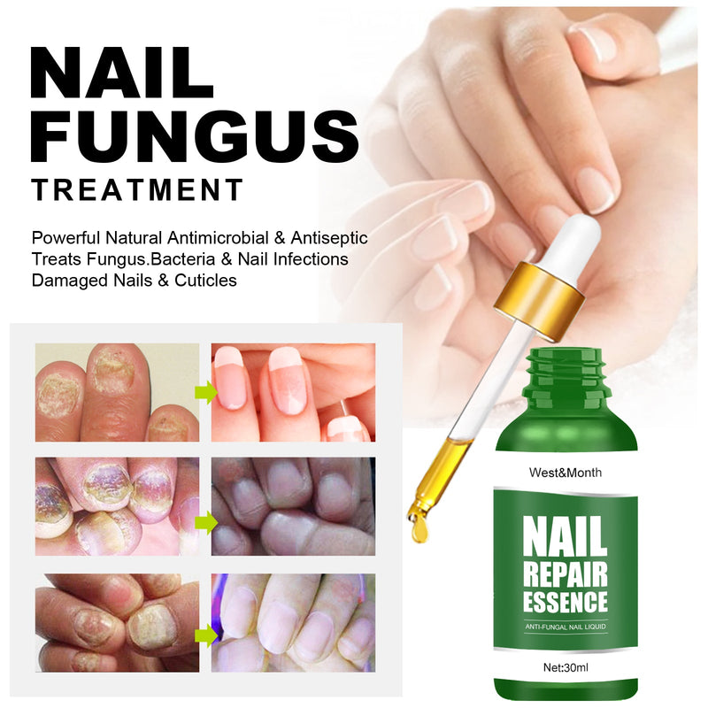 West&Month Nail Repair Essence, Hand And Foot Thickening Brightening Nails Repair Rotten Nails Bad Nails Remove Ash Nail Infection Clean