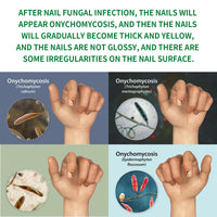 Ginger Nail Care Solution, Repair Hand, Foot And Nail Care Soft Nail Shine Moisturizer Gray Nails