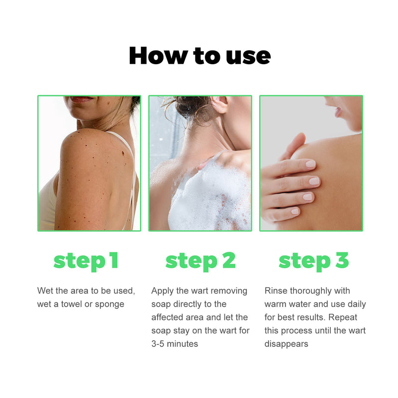 South Moon Skin Tag Removal Rubber Band, Remove Moles Remove Warts Face Neck Flesh Granule Body Cleansing Soap