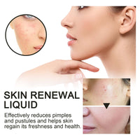 Skin Renewal Liquid, Reduce Acne Print Repair Acne Muscle Mild Clear Acne Hydrating Essence