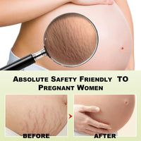 Tummy Tucking Cream, Moisturizing And Smoothing Skin Repair Cream For Surgical Scars And Pregnancy Wounds
