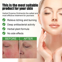 South Moon Herbal Eczema Ointment, Relieve Hand And Foot Moss Skin Redness Itchy Skin Repair Ointment