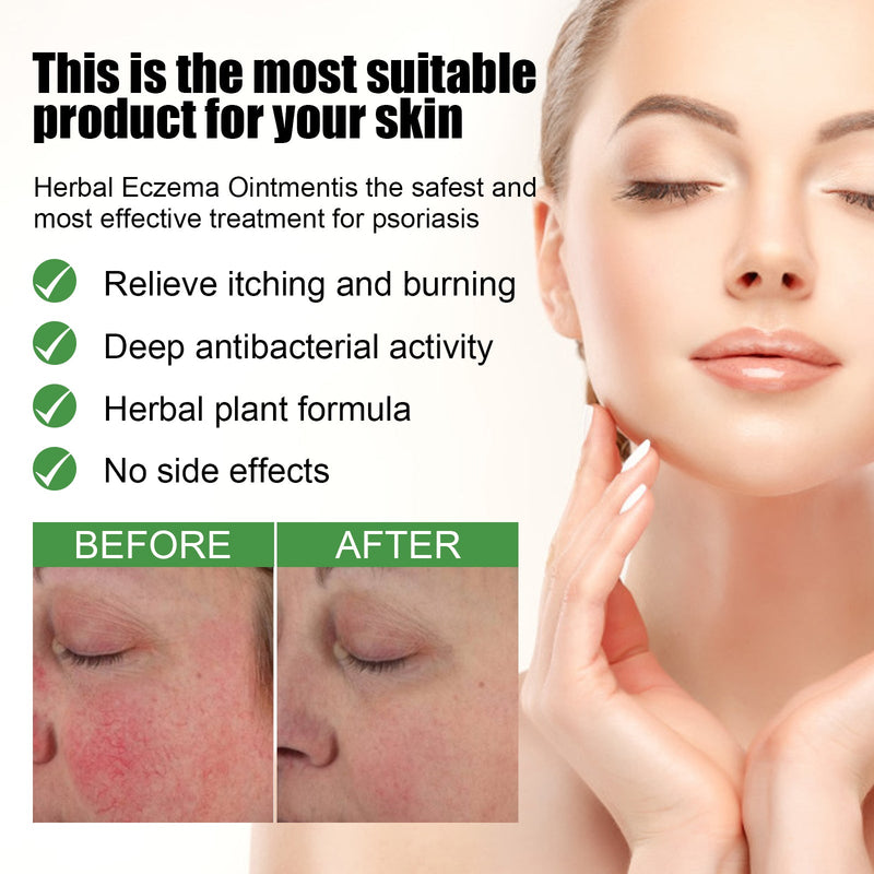 South Moon Herbal Eczema Ointment, Relieve Hand And Foot Moss Skin Redness Itchy Skin Repair Ointment