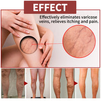 EELHOE Venous Massage Varicose Cream, Relieves Bulging Leg Blood Vessels And Swollen Leg Earthworm Venous Massage Cream
