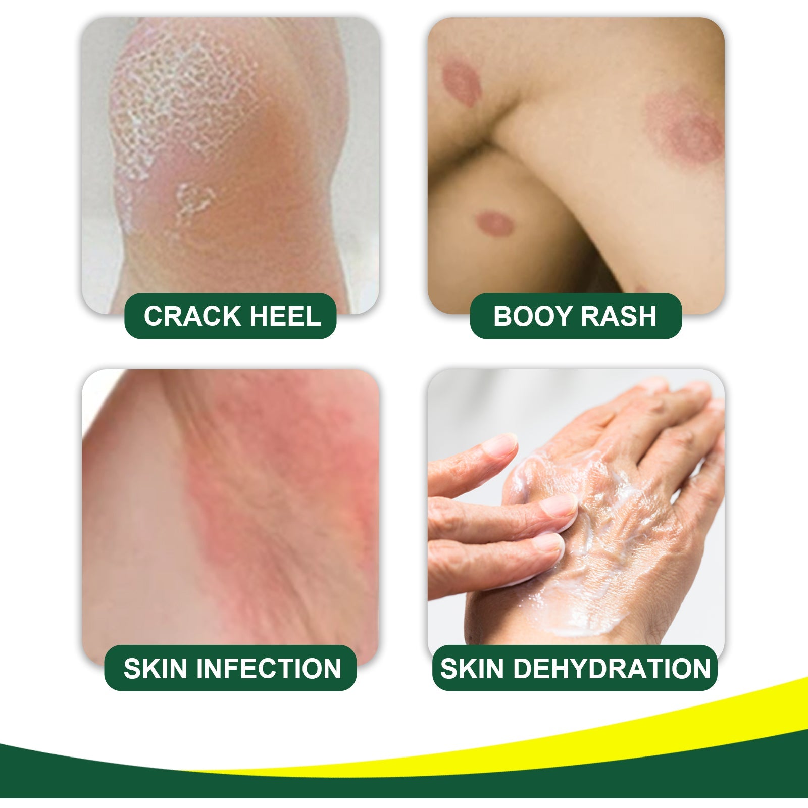 Herbal Tinea Corproris Cream, Mild Non-Irritating Ointment For Itch Relief External Ointment For The Body