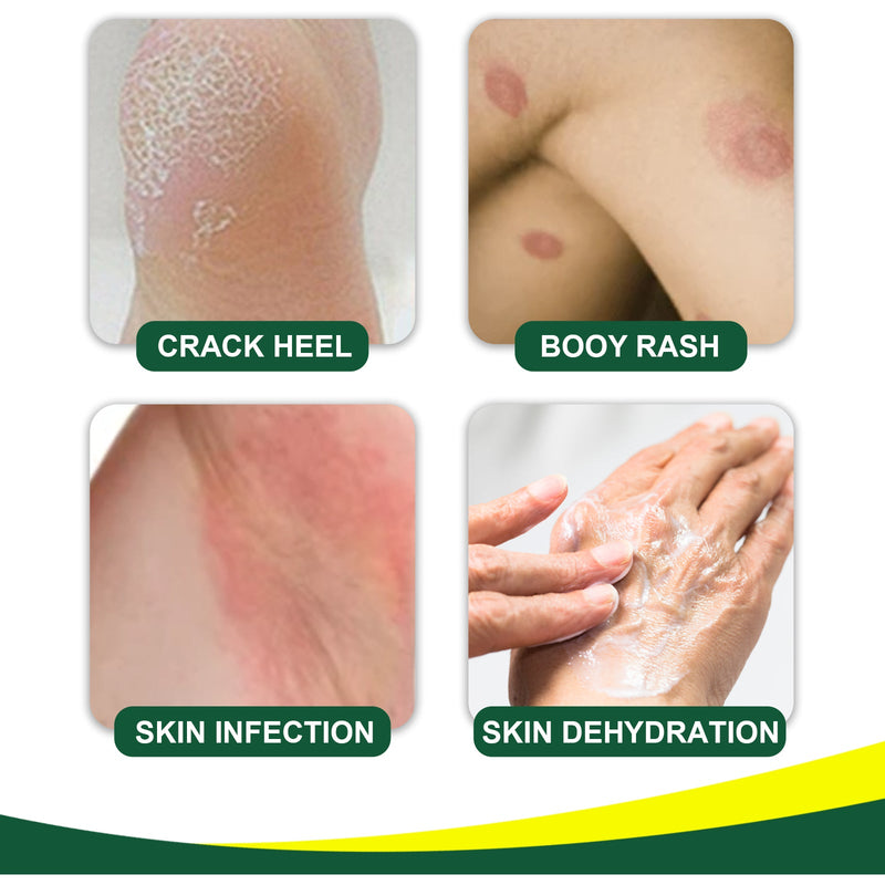 Herbal Tinea Corproris Cream, Mild Non-Irritating Ointment For Itch Relief External Ointment For The Body