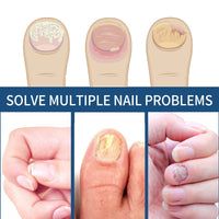 EELHOE Fungal Nail Patches, Toenail Care Soft Nail, Inlay Nail And Thickening Nail Repair Patch