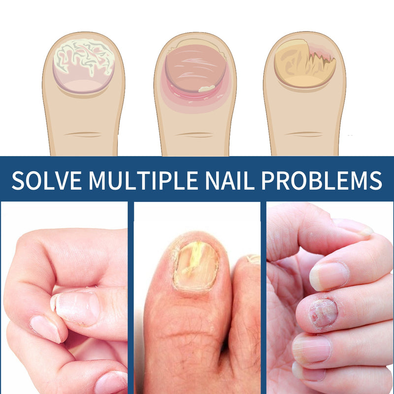 EELHOE Fungal Nail Patches, Toenail Care Soft Nail, Inlay Nail And Thickening Nail Repair Patch