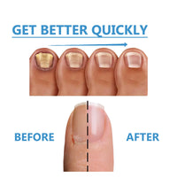 Toenail Fungus Treatment, Repair The Brotherhood Of Nails Rotten Jiasheng Mail This Soft Armour A Detailer