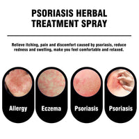 Psoriasis Herbal Treatment Spray, Repair Hands And Feet Skin Redness And Itchiness Moisturizing Smooth Skin Care Spray